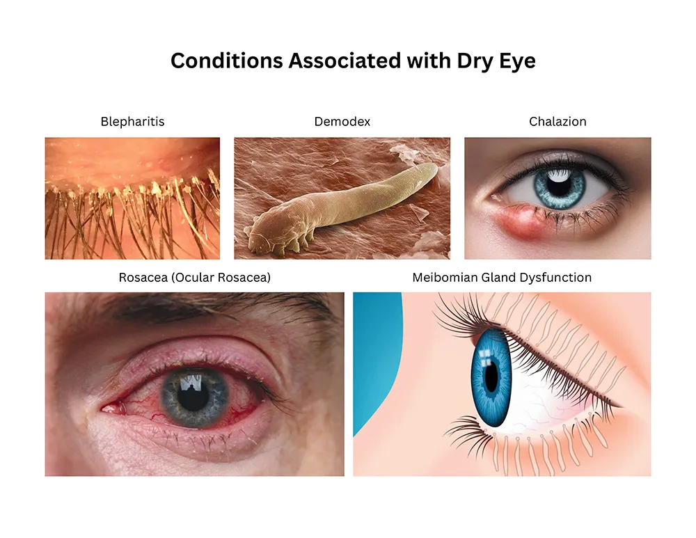 A diagram showing the common conditions associated with dry eye
