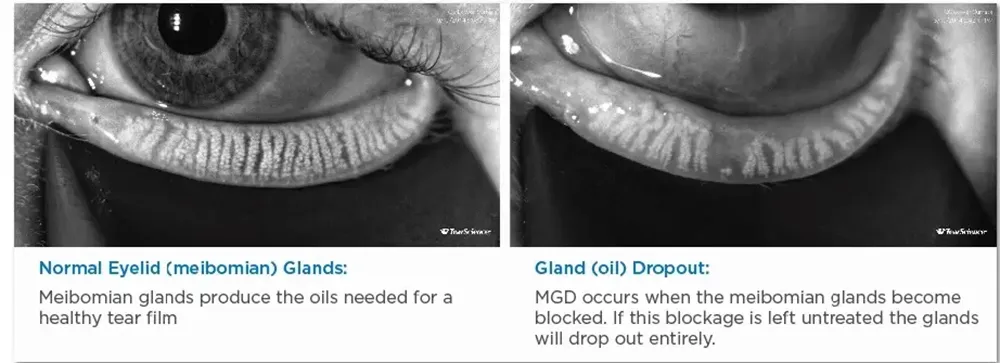 A diagram showing normal eyelid glands vs clogged glands